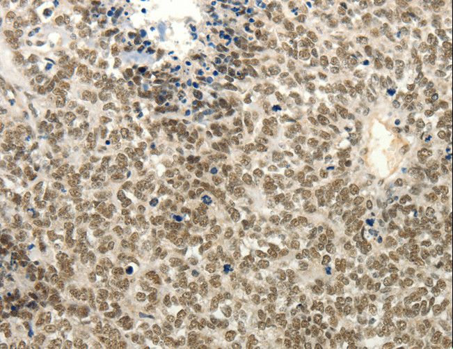 FZD10 / Frizzled 10 Antibody - Immunohistochemistry of paraffin-embedded Human ovarian cancer using FZD10 Polyclonal Antibody at dilution of 1:50.