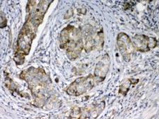 FZD3 / Frizzled 3 Antibody - IHC testing of FFPE human breast cancer tissue with FZD3 antibody at 1ug/ml. Required HIER: steam section in pH6 citrate buffer for 20 min and allow to cool prior to testing.