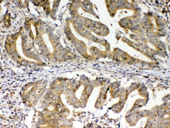 FZD3 / Frizzled 3 Antibody - IHC testing of FFPE human colon cancer tissue with FZD3 antibody at 1ug/ml. Required HIER: steam section in pH6 citrate buffer for 20 min and allow to cool prior to testing.