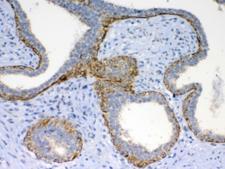 FZD4 / Frizzled 4 Antibody - IHC testing of FFPE human breast cancer tissue with FZD4 antibody at 1ug/ml. Required HIER: steam section in pH6 citrate buffer for 20 min and allow to cool prior to testing.