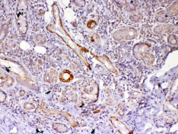 FZD4 / Frizzled 4 Antibody - IHC testing of FFPE human lung cancer tissue with FZD4 antibody at 1ug/ml. Required HIER: steam section in pH6 citrate buffer for 20 min and allow to cool prior to testing.