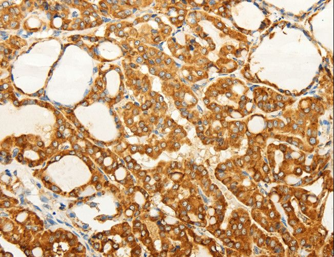 FZD6 / Frizzled 6 Antibody - Immunohistochemistry of paraffin-embedded Human gastric cancer using FZD6 Polyclonal Antibody at dilution of 1:60.