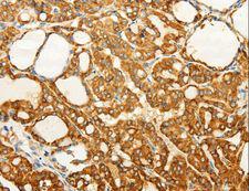 FZD6 / Frizzled 6 Antibody - Immunohistochemistry of paraffin-embedded Human gastric cancer using FZD6 Polyclonal Antibody at dilution of 1:60.