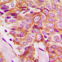 FZD8 / Frizzled 8 Antibody - Immunohistochemical analysis of Frizzled 8 staining in human breast cancer formalin fixed paraffin embedded tissue section. The section was pre-treated using heat mediated antigen retrieval with sodium citrate buffer (pH 6.0). The section was then incubated with the antibody at room temperature and detected using an HRP conjugated compact polymer system. DAB was used as the chromogen. The section was then counterstained with hematoxylin and mounted with DPX.