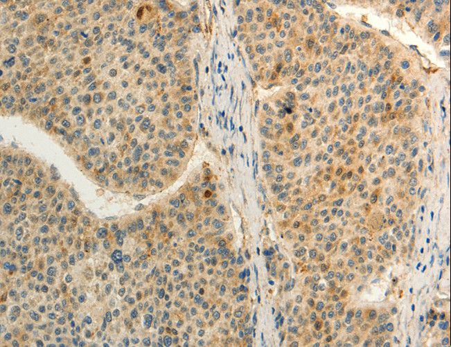 FZD8 / Frizzled 8 Antibody - Immunohistochemistry of paraffin-embedded Human liver cancer using FZD8 Polyclonal Antibody at dilution of 1:50.