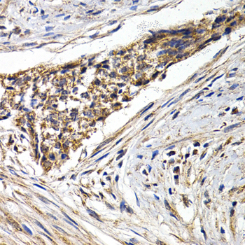 FZR1 Antibody - Immunohistochemistry of paraffin-embedded human esophagus cancer tissue.