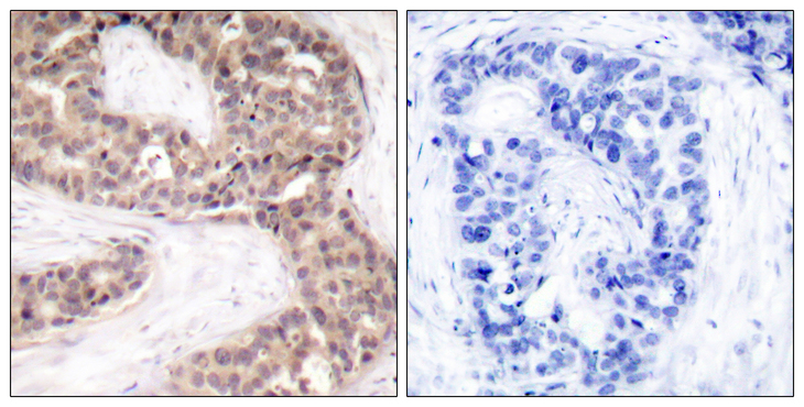 G3BP1 / G3BP Antibody - Immunohistochemistry analysis of paraffin-embedded human breast carcinoma tissue, using G3BP-1 Antibody. The picture on the right is blocked with the synthesized peptide.