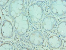 G3BP1 / G3BP Antibody - Immunohistochemistry of paraffin-embedded human colon cancer using antibody at 1:100 dilution.