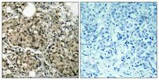 G3BP1 / G3BP Antibody - Peptide - + Immunohistochemical analysis of paraffin-embedded human breast carcinoma tissue using G3BP-1 (Ab-232) antibody.