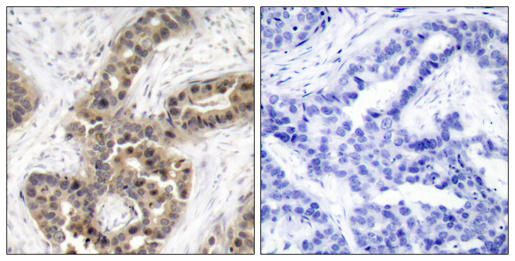 G3BP1 / G3BP Antibody - Immunohistochemistry analysis of paraffin-embedded human breast carcinoma, using G3BP-1 (Phospho-Ser232) Antibody. The picture on the right is treated with the synthesized peptide.
