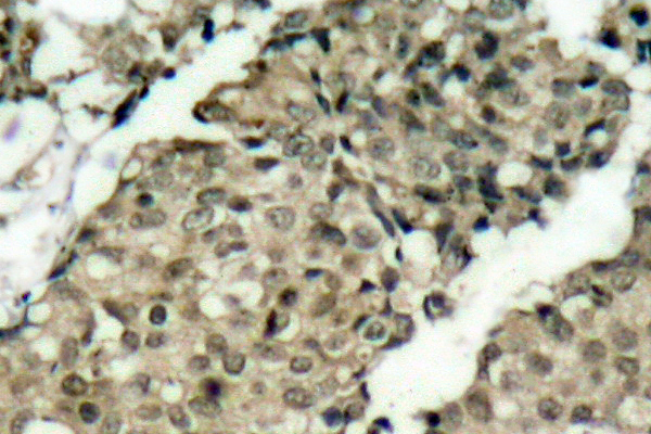 G3BP1 / G3BP Antibody - IHC of p-G3BP-1 (S232) pAb in paraffin-embedded human breast carcinoma tissue.
