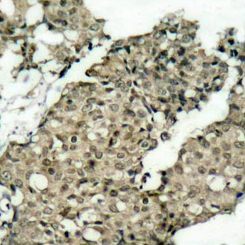 G3BP1 / G3BP Antibody - Immunohistochemical analysis of paraffin-embedded human breast carcinoma tissue.