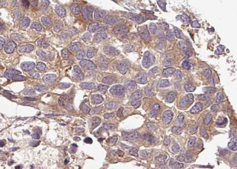G3BP1 / G3BP Antibody - 1:100 staining human breast carcinoma tissue by IHC-P. The tissue was formaldehyde fixed and a heat mediated antigen retrieval step in citrate buffer was performed. The tissue was then blocked and incubated with the antibody for 1.5 hours at 22°C. An HRP conjugated goat anti-rabbit antibody was used as the secondary.