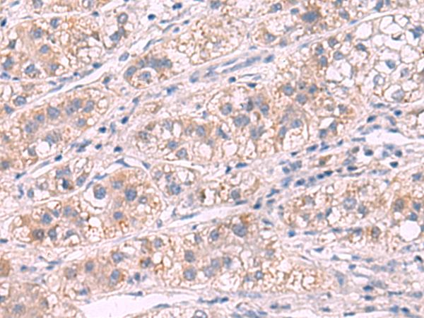 G6PC / Glucose-6-Phosphatase Antibody - Immunohistochemistry of paraffin-embedded Human liver cancer tissue  using G6PC Polyclonal Antibody at dilution of 1:50(×200)
