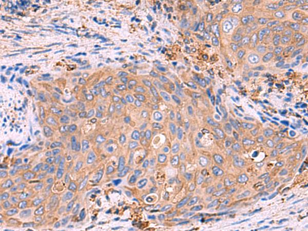 G6PC / Glucose-6-Phosphatase Antibody - Immunohistochemistry of paraffin-embedded Human cervical cancer tissue  using G6PC Polyclonal Antibody at dilution of 1:70(×200)