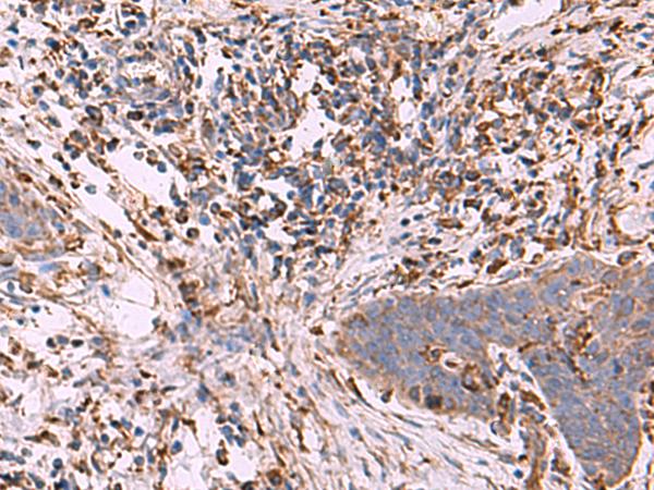 G6PC / Glucose-6-Phosphatase Antibody - Immunohistochemistry of paraffin-embedded Human esophagus cancer tissue  using G6PC Polyclonal Antibody at dilution of 1:70(×200)