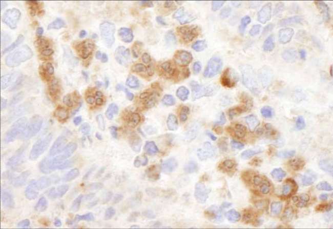 G6PD Antibody - Detection of Human G6PD by Immunohistochemistry. Samples: FFPE section of human stomach adenocarcinoma. Antibody: Affinity purified rabbit anti-G6PD used at a dilution of 1:500. Detection: DAB.