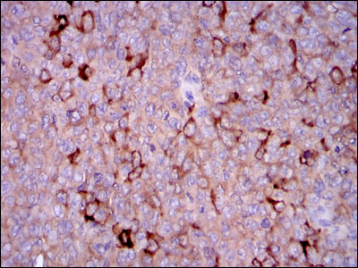 G6PD Antibody - IHC of paraffin-embedded ovarian cancer tissues using G6PD mouse monoclonal antibody with DAB staining.