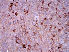 G6PD Antibody - IHC of paraffin-embedded ovarian cancer tissues using G6PD mouse monoclonal antibody with DAB staining.