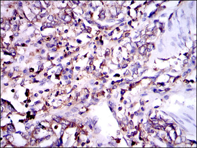 G6PD Antibody - IHC of paraffin-embedded stomach cancer tissues using G6PD mouse monoclonal antibody with DAB staining.
