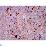 G6PD Antibody - Immunohistochemistry (IHC) analysis of paraffin-embedded ovarian cancer tissues with DAB staining using G6PD Monoclonal Antibody.
