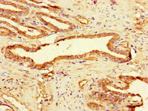 GAA / Alpha-Glucosidase, Acid Antibody - Immunohistochemistry of paraffin-embedded human prostate cancer at dilution of 1:100