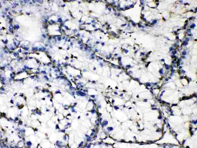 GAA / Alpha-Glucosidase, Acid Antibody - GAA was detected in paraffin-embedded sections of human liver cancer tissues using rabbit anti-GAA Antigen Affinity purified polyclonal antibody at 1 µg/mL. The immunohistochemical section was developed using SABC method
