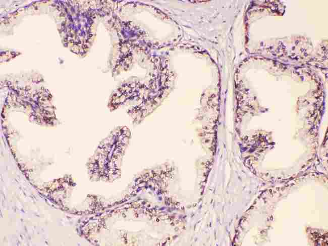 GAA / Alpha-Glucosidase, Acid Antibody - GAA was detected in paraffin-embedded sections of human prostatic cancer tissues using rabbit anti-GAA Antigen Affinity purified polyclonal antibody at 1 µg/mL. The immunohistochemical section was developed using SABC method