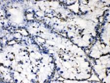GAA / Alpha-Glucosidase, Acid Antibody - IHC testing of FFPE human liver cancer tissue with GAA antibody at 1ug/ml. HIER: steam section in pH6 citrate buffer for 20 min.