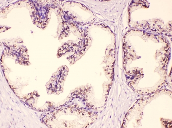 GAA / Alpha-Glucosidase, Acid Antibody - IHC testing of FFPE human prostate cancer tissue with GAA antibody at 1ug/ml. HIER: steam section in pH6 citrate buffer for 20 min.