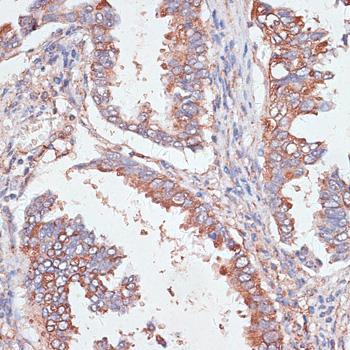 GAB1 Antibody - Immunohistochemistry of paraffin-embedded Human lung cancer using GAB1 Polyclonal Antibody at dilution of 1:100 (40x lens).