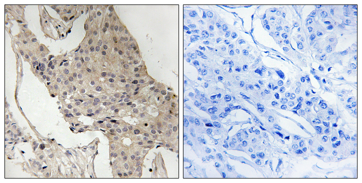 GAB2 Antibody - Immunohistochemistry analysis of paraffin-embedded human breast carcinoma, using Gab2 (Phospho-Ser623) Antibody. The picture on the right is blocked with the phospho peptide.