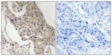 GAB2 Antibody - Immunohistochemistry analysis of paraffin-embedded human breast carcinoma, using Gab2 (Phospho-Ser623) Antibody. The picture on the right is blocked with the phospho peptide.