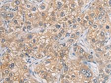 GAB4 Antibody - Immunohistochemistry of paraffin-embedded Human liver cancer tissue  using GAB4 Polyclonal Antibody at dilution of 1:60(×200)