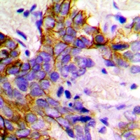 GABARAP Antibody - Immunohistochemical analysis of GABARAP staining in human breast cancer formalin fixed paraffin embedded tissue section. The section was pre-treated using heat mediated antigen retrieval with sodium citrate buffer (pH 6.0). The section was then incubated with the antibody at room temperature and detected using an HRP conjugated compact polymer system. DAB was used as the chromogen. The section was then counterstained with hematoxylin and mounted with DPX.