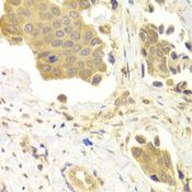 GABARAP Antibody - Immunohistochemistry of paraffin-embedded human mammary cancer using GABARAP antibody at dilution of 1:100 (40x lens).