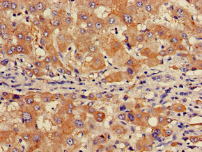GABARAPL1 / ATG8 Antibody - Immunohistochemistry of paraffin-embedded human liver cancer using GABARAPL1 Antibody at dilution of 1:100