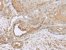 GABARAPL2 / ATG8 Antibody - Immunohistochemistry of paraffin-embedded Human thyroid cancer tissue  using GABARAPL2 Polyclonal Antibody at dilution of 1:55(×200)