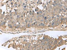 GABARAPL2 / ATG8 Antibody - Immunohistochemistry of paraffin-embedded Human liver cancer tissue  using GABARAPL2 Polyclonal Antibody at dilution of 1:60(×200)