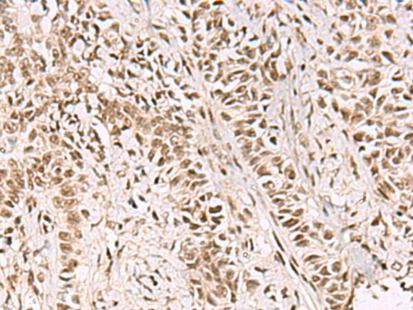 GABPB1 Antibody - Immunohistochemistry of paraffin-embedded Human ovarian cancer tissue  using GABPB1 Polyclonal Antibody at dilution of 1:55(×200)