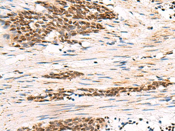 GABPB1 Antibody - Immunohistochemistry of paraffin-embedded Human esophagus cancer tissue  using GABPB1 Polyclonal Antibody at dilution of 1:55(×200)