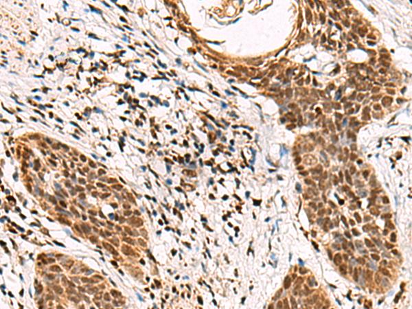 GABPB1 Antibody - Immunohistochemistry of paraffin-embedded Human esophagus cancer tissue  using GABPB1 Polyclonal Antibody at dilution of 1:70(×200)