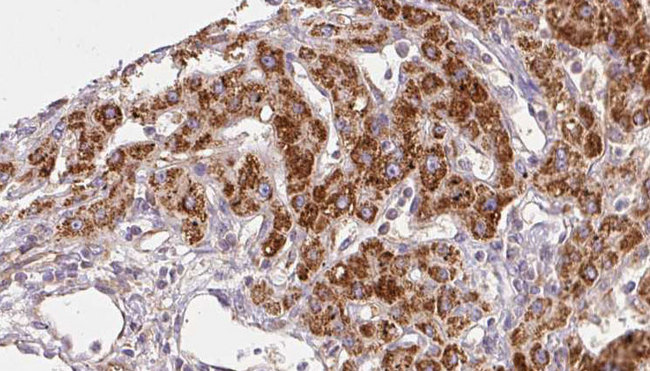 GABRA1 Antibody - 1:100 staining human liver carcinoma tissues by IHC-P. The sample was formaldehyde fixed and a heat mediated antigen retrieval step in citrate buffer was performed. The sample was then blocked and incubated with the antibody for 1.5 hours at 22°C. An HRP conjugated goat anti-rabbit antibody was used as the secondary.