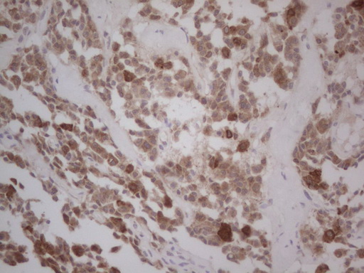 GABRA5 Antibody - Immunohistochemical staining of paraffin-embedded Carcinoma of Human lung tissue using anti-GABRA5 mouse monoclonal antibody. (Heat-induced epitope retrieval by Tris-EDTA, pH8.0) Dilution: 1:150