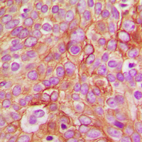 GABRB1 Antibody - Immunohistochemical analysis of GABRB1 (pS434) staining in human breast cancer formalin fixed paraffin embedded tissue section. The section was pre-treated using heat mediated antigen retrieval with sodium citrate buffer (pH 6.0). The section was then incubated with the antibody at room temperature and detected using an HRP conjugated compact polymer system. DAB was used as the chromogen. The section was then counterstained with hematoxylin and mounted with DPX.