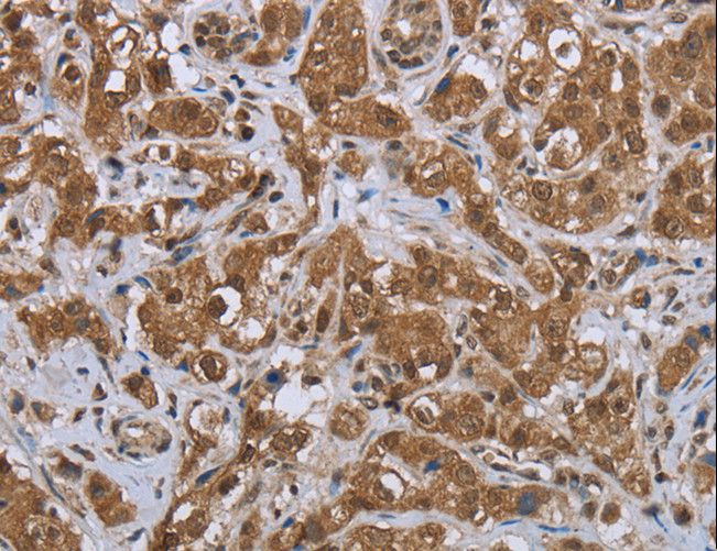 GABRB1 Antibody - Immunohistochemistry of paraffin-embedded Human breast cancer using GABRB1 Polyclonal Antibody at dilution of 1:50.