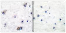 GABRB1 Antibody - P-peptide - + Immunohistochemical analysis of paraffin-embedded human breast carcinoma tissue, using GABA-RB (phospho-Ser434) antibody.