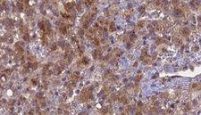 GABRB2 Antibody - 1:100 staining human liver carcinoma tissues by IHC-P. The sample was formaldehyde fixed and a heat mediated antigen retrieval step in citrate buffer was performed. The sample was then blocked and incubated with the antibody for 1.5 hours at 22°C. An HRP conjugated goat anti-rabbit antibody was used as the secondary.