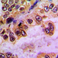 GABRD Antibody - Immunohistochemical analysis of GABRD staining in human lung cancer formalin fixed paraffin embedded tissue section. The section was pre-treated using heat mediated antigen retrieval with sodium citrate buffer (pH 6.0). The section was then incubated with the antibody at room temperature and detected with HRP and DAB as chromogen. The section was then counterstained with hematoxylin and mounted with DPX.