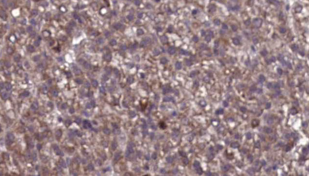 GABRG2 Antibody - 1:100 staining human liver carcinoma tissues by IHC-P. The sample was formaldehyde fixed and a heat mediated antigen retrieval step in citrate buffer was performed. The sample was then blocked and incubated with the antibody for 1.5 hours at 22°C. An HRP conjugated goat anti-rabbit antibody was used as the secondary.